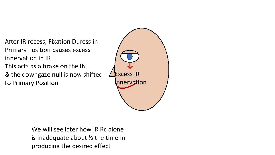 After IR recess, Fixation Duress in Primary Position causes excess innervation in IR This After IR recess, Fixation Duress in Primary Position causes excess innervation in IR This