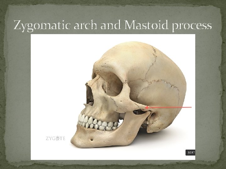 Zygomatic arch and Mastoid process 