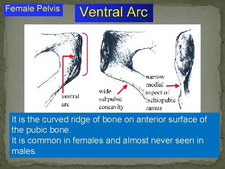 It is the curved ridge of bone on anterior surface of the pubic bone.
