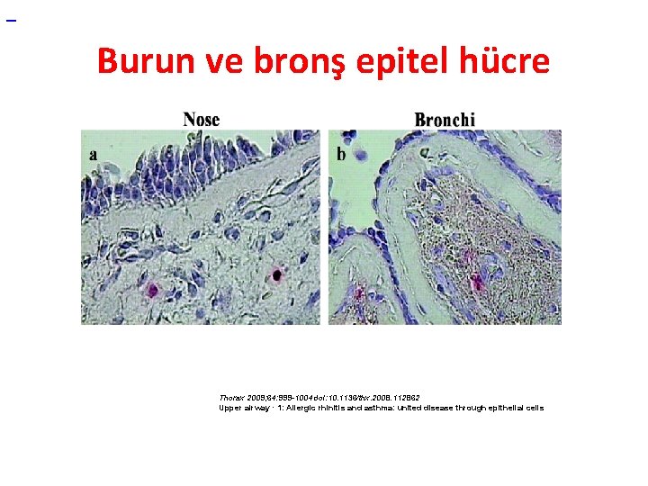  Burun ve bronş epitel hücre Thorax 2009; 64: 999 -1004 doi: 10. 1136/thx.