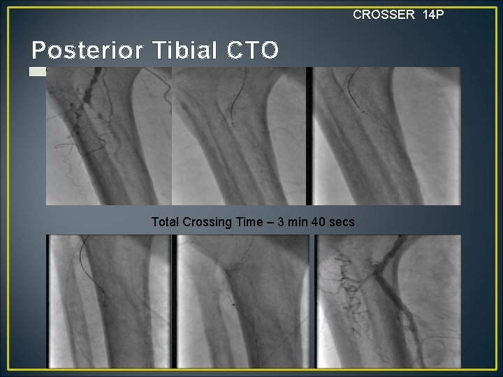 CROSSER 14 P Posterior Tibial CTO Total Crossing Time – 3 min 40 secs