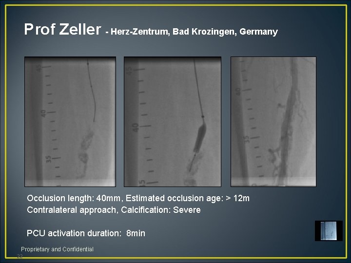 Prof Zeller - Herz-Zentrum, Bad Krozingen, Germany Occlusion length: 40 mm, Estimated occlusion age: