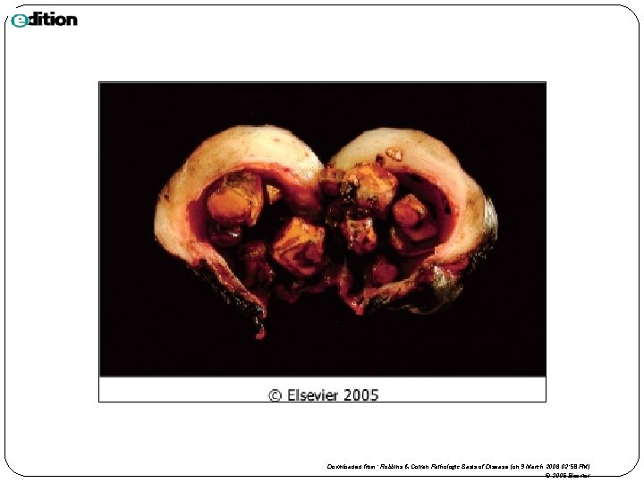 Downloaded from: Robbins & Cotran Pathologic Basis of Disease (on 9 March 2006 02: