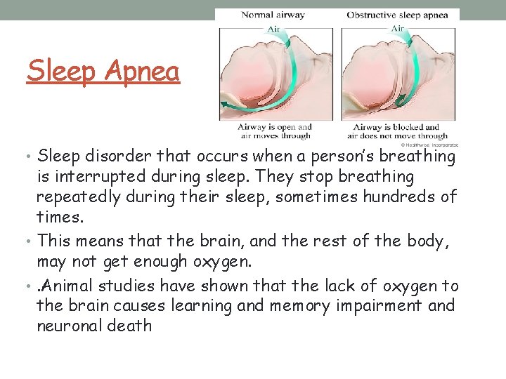 Sleep Apnea • Sleep disorder that occurs when a person’s breathing is interrupted during