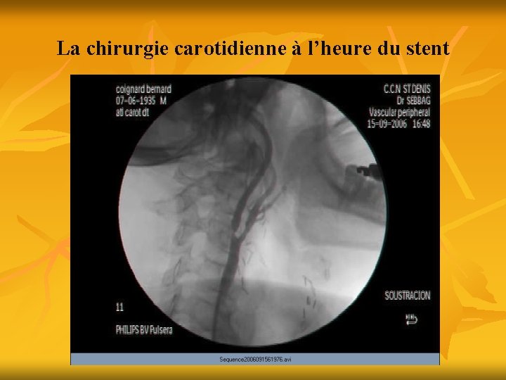 La chirurgie carotidienne à l’heure du stent 