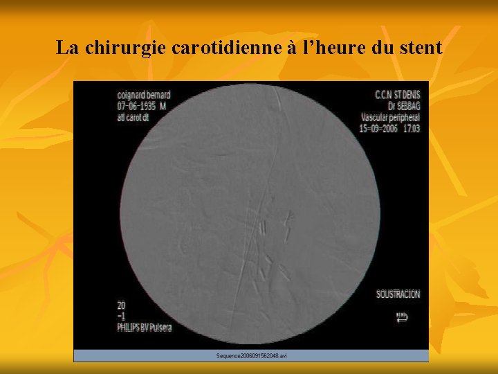 La chirurgie carotidienne à l’heure du stent 