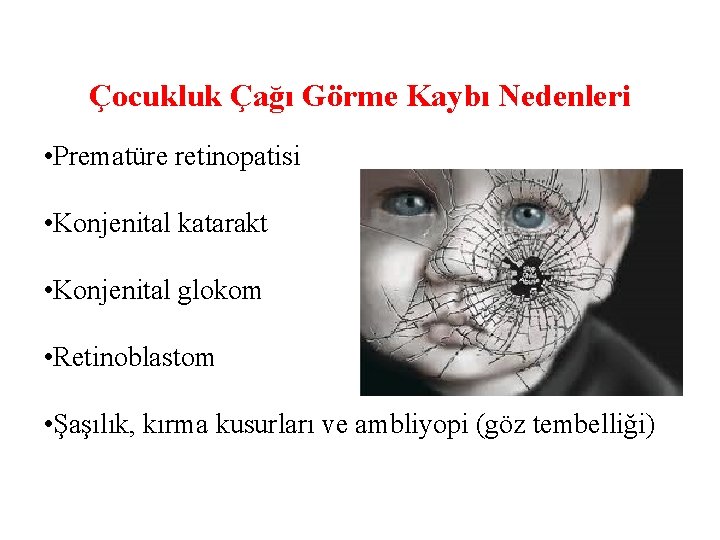 Çocukluk Çağı Görme Kaybı Nedenleri • Prematüre retinopatisi • Konjenital katarakt • Konjenital glokom