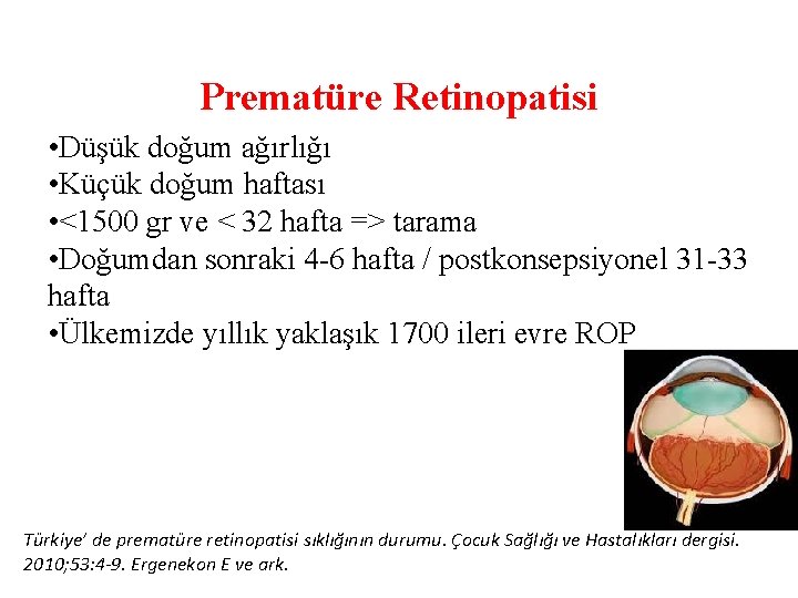 Prematüre Retinopatisi • Düşük doğum ağırlığı • Küçük doğum haftası • <1500 gr ve