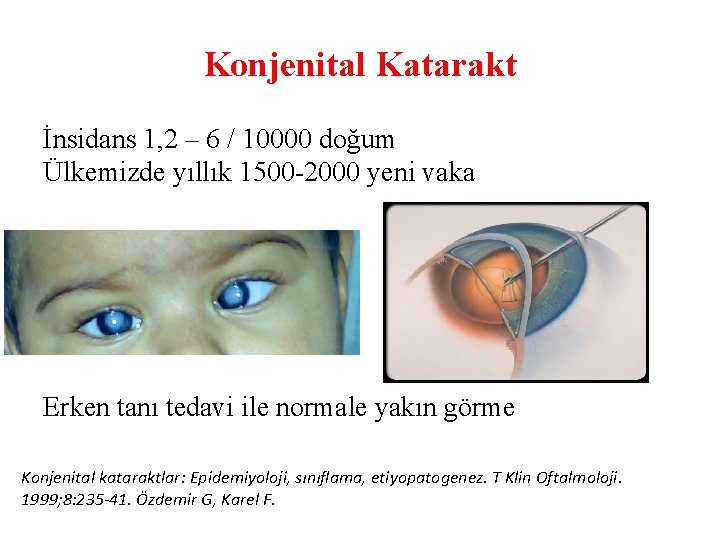 Konjenital Katarakt İnsidans 1, 2 – 6 / 10000 doğum Ülkemizde yıllık 1500 -2000