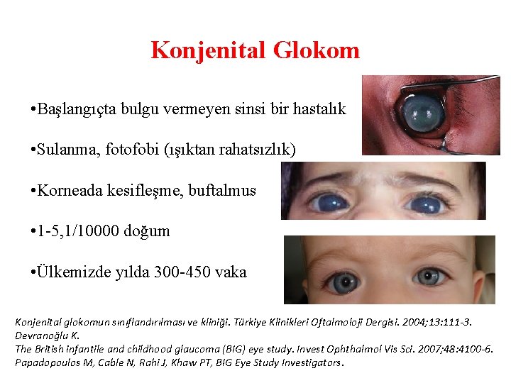 Konjenital Glokom • Başlangıçta bulgu vermeyen sinsi bir hastalık • Sulanma, fotofobi (ışıktan rahatsızlık)