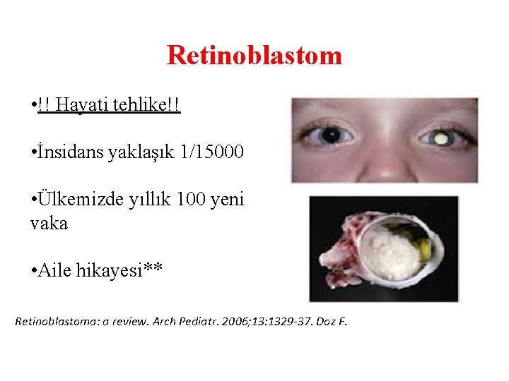 Retinoblastom • !! Hayati tehlike!! • İnsidans yaklaşık 1/15000 • Ülkemizde yıllık 100 yeni