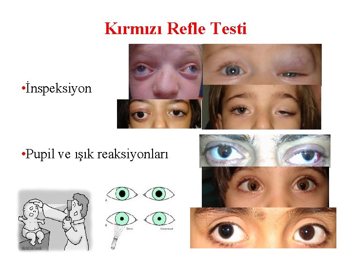 Kırmızı Refle Testi • İnspeksiyon • Pupil ve ışık reaksiyonları 