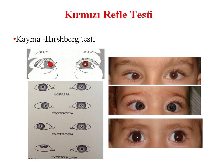 Kırmızı Refle Testi • Kayma -Hirshberg testi 