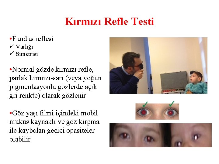 Kırmızı Refle Testi • Fundus reflesi Varlığı Simetrisi • Normal gözde kırmızı refle, parlak