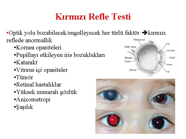 Kırmızı Refle Testi • Optik yolu bozabilecek/engelleyecek her türlü faktör kırmızı reflede anormallik •