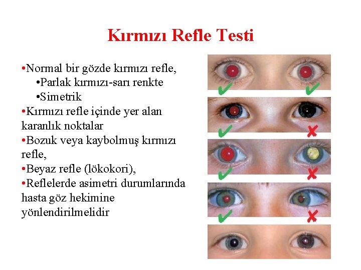 Kırmızı Refle Testi • Normal bir gözde kırmızı refle, • Parlak kırmızı-sarı renkte •