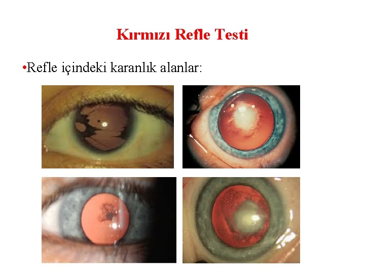 Kırmızı Refle Testi • Refle içindeki karanlık alanlar: 