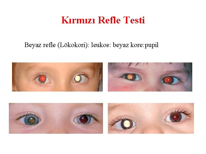 Kırmızı Refle Testi Beyaz refle (Lökokori): leukos: beyaz kore: pupil 