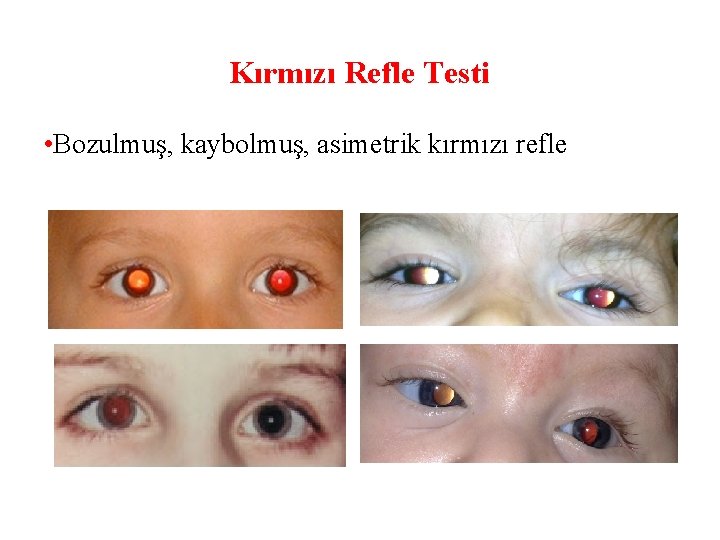 Kırmızı Refle Testi • Bozulmuş, kaybolmuş, asimetrik kırmızı refle 