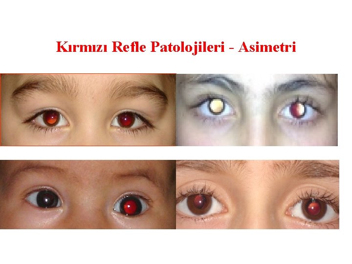 Kırmızı Refle Patolojileri - Asimetri 