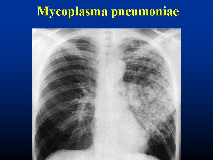 Mycoplasma pneumoniae 