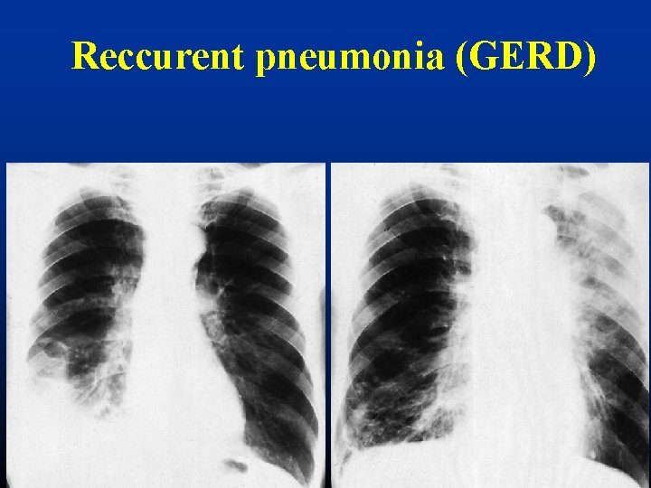 Reccurent pneumonia (GERD) 