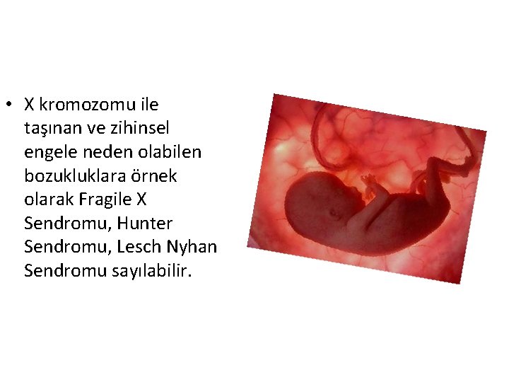  • X kromozomu ile taşınan ve zihinsel engele neden olabilen bozukluklara örnek olarak