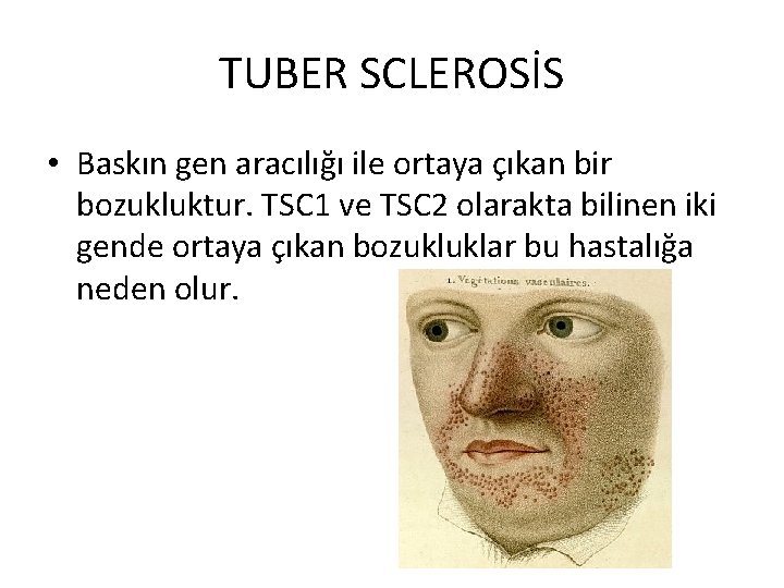 TUBER SCLEROSİS • Baskın gen aracılığı ile ortaya çıkan bir bozukluktur. TSC 1 ve