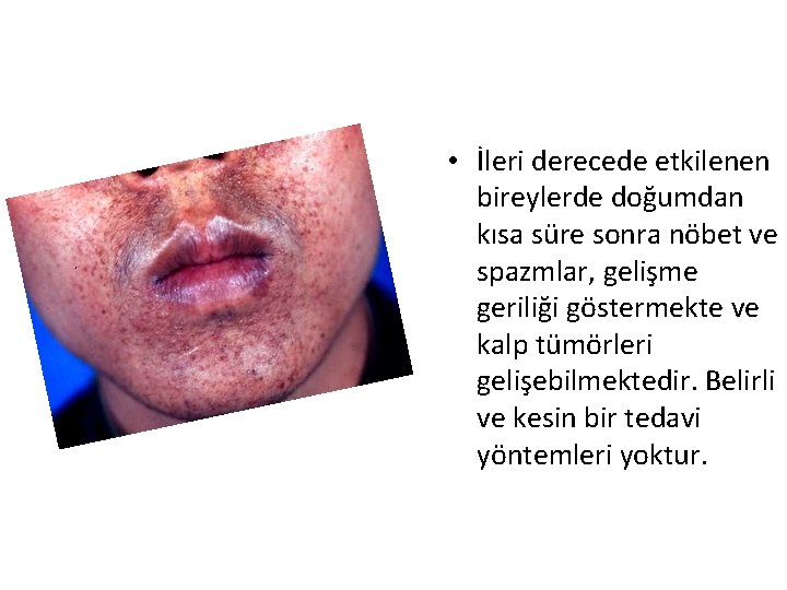  • İleri derecede etkilenen bireylerde doğumdan kısa süre sonra nöbet ve spazmlar, gelişme