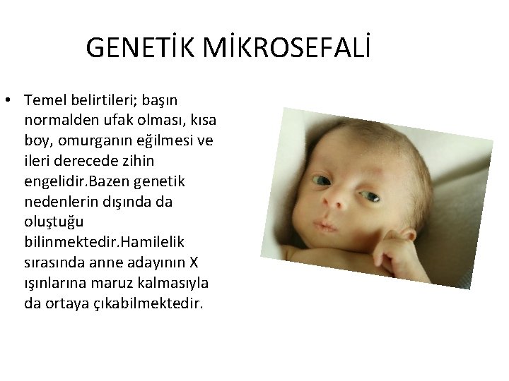 GENETİK MİKROSEFALİ • Temel belirtileri; başın normalden ufak olması, kısa boy, omurganın eğilmesi ve