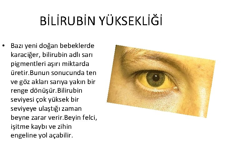 BİLİRUBİN YÜKSEKLİĞİ • Bazı yeni doğan bebeklerde karaciğer, bilirubin adlı sarı pigmentleri aşırı miktarda