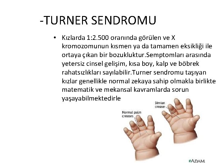 -TURNER SENDROMU • Kızlarda 1: 2. 500 oranında görülen ve X kromozomunun kısmen ya