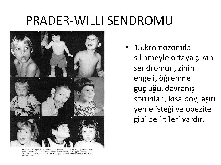 PRADER-WILLI SENDROMU • 15. kromozomda silinmeyle ortaya çıkan sendromun, zihin engeli, öğrenme güçlüğü, davranış