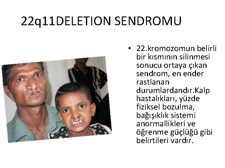 22 q 11 DELETION SENDROMU • 22. kromozomun belirli bir kısmının silinmesi sonucu ortaya