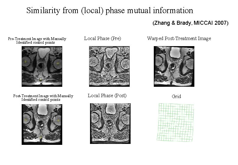 Similarity from (local) phase mutual information (Zhang & Brady, MICCAI 2007) Pre-Treatment Image with