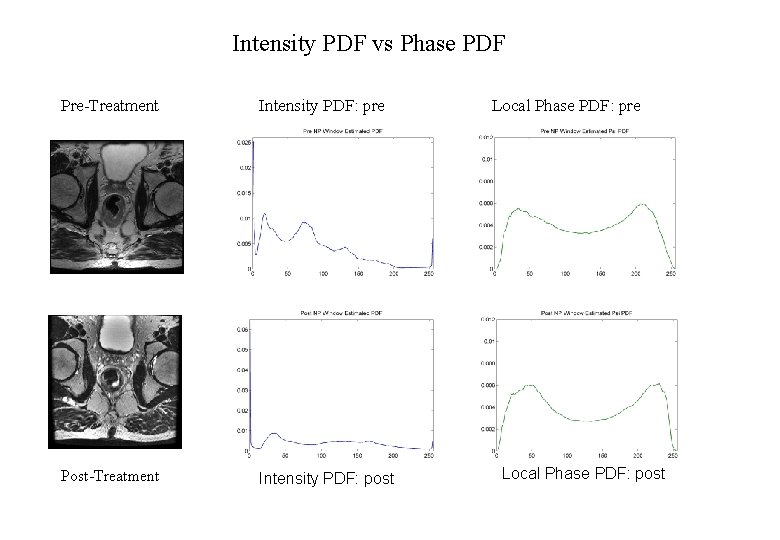 Intensity PDF vs Phase PDF Pre-Treatment Intensity PDF: pre Post-Treatment Intensity PDF: post Local