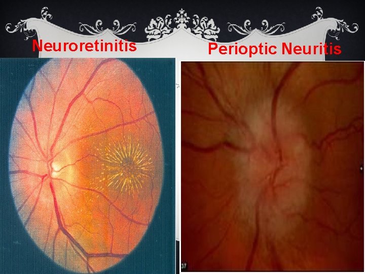 Neuroretinitis Perioptic Neuritis Neuroretinitis Perioptic Neuritis