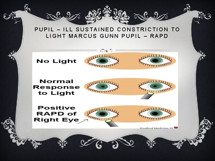 PUPIL – ILL SUSTAINED CONSTRICTION TO LIGHT MARCUS GUNN PUPIL – RAPD PUPIL – ILL SUSTAINED CONSTRICTION TO LIGHT MARCUS GUNN PUPIL – RAPD