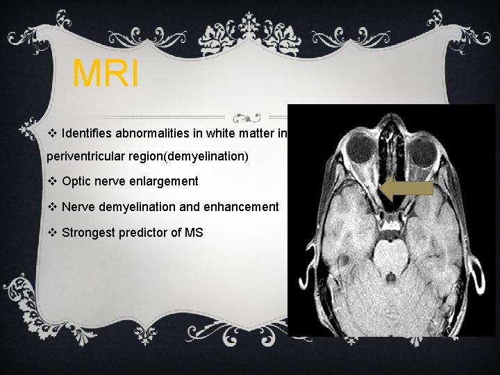 MRI v Identifies abnormalities in white matter in periventricular region(demyelination) v Optic nerve enlargement MRI v Identifies abnormalities in white matter in periventricular region(demyelination) v Optic nerve enlargement