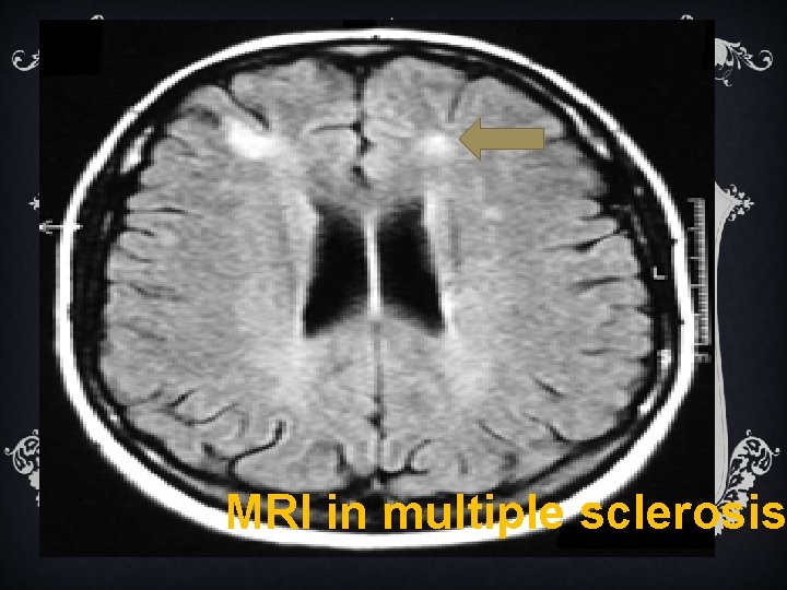 MRI in multiple sclerosis MRI in multiple sclerosis