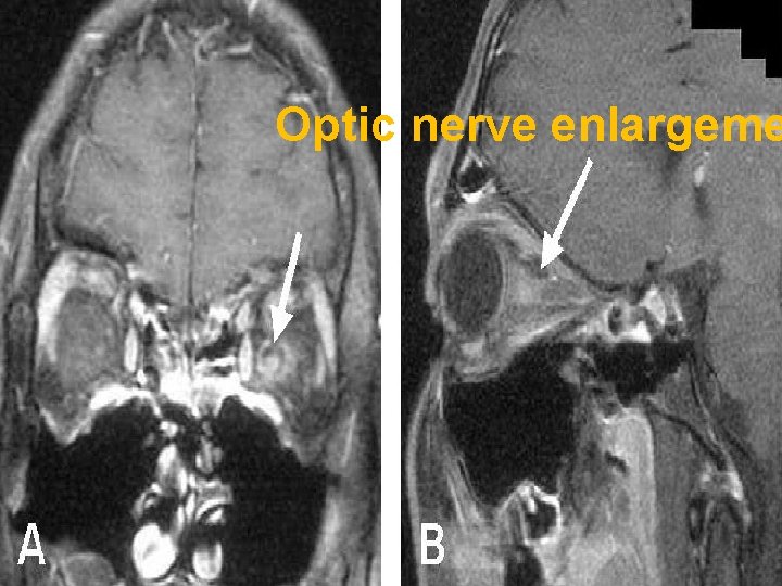 Optic nerve enlargeme Optic nerve enlargeme