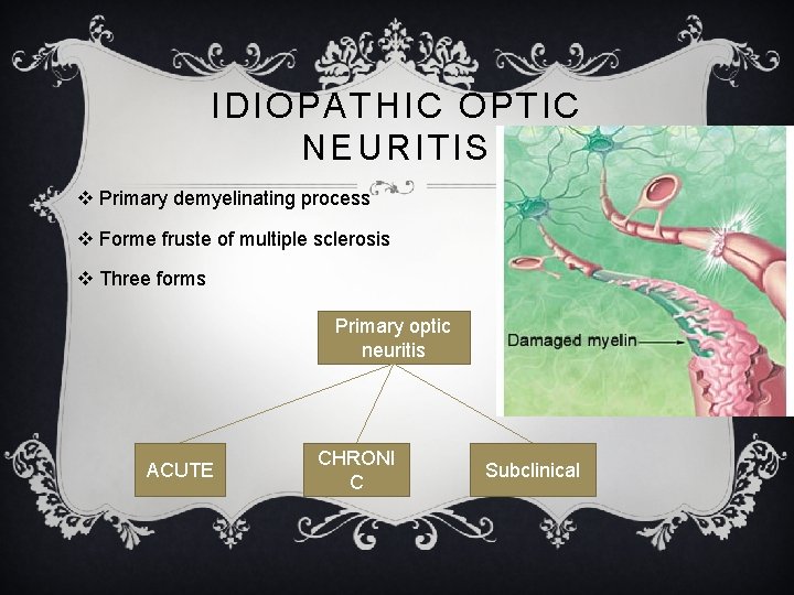 IDIOPATHIC OPTIC NEURITIS v Primary demyelinating process v Forme fruste of multiple sclerosis v IDIOPATHIC OPTIC NEURITIS v Primary demyelinating process v Forme fruste of multiple sclerosis v