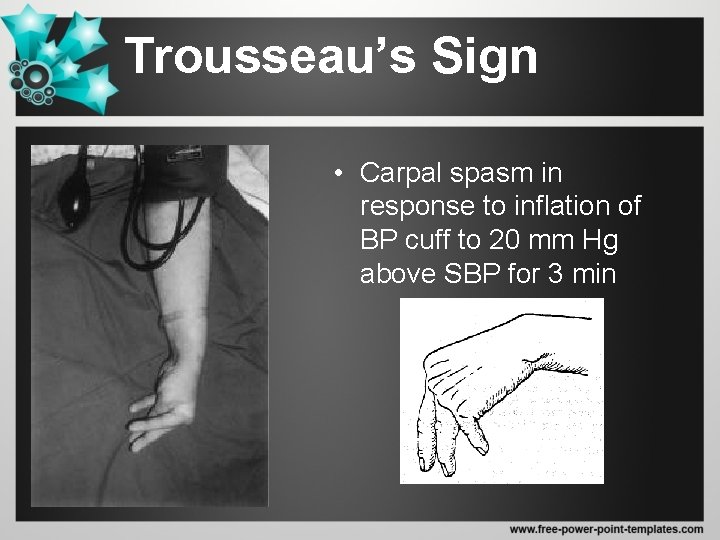 Trousseau’s Sign • Carpal spasm in response to inflation of BP cuff to 20