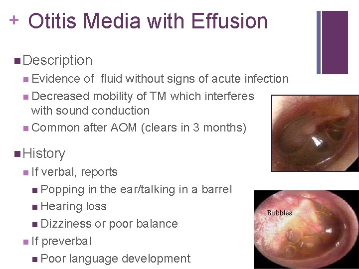 + Otitis Media with Effusion Description Evidence of fluid without signs of acute infection