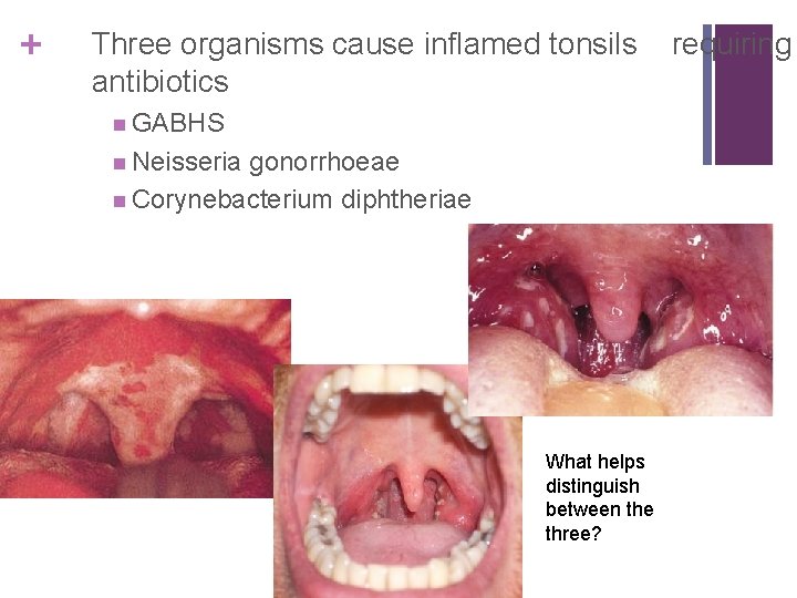 + Three organisms cause inflamed tonsils antibiotics GABHS Neisseria gonorrhoeae Corynebacterium diphtheriae What helps
