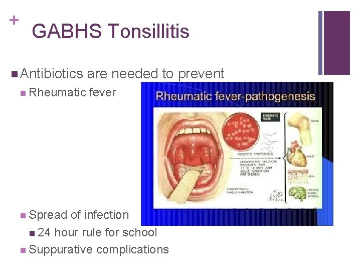 + GABHS Tonsillitis Antibiotics Rheumatic Spread are needed to prevent fever of infection 24