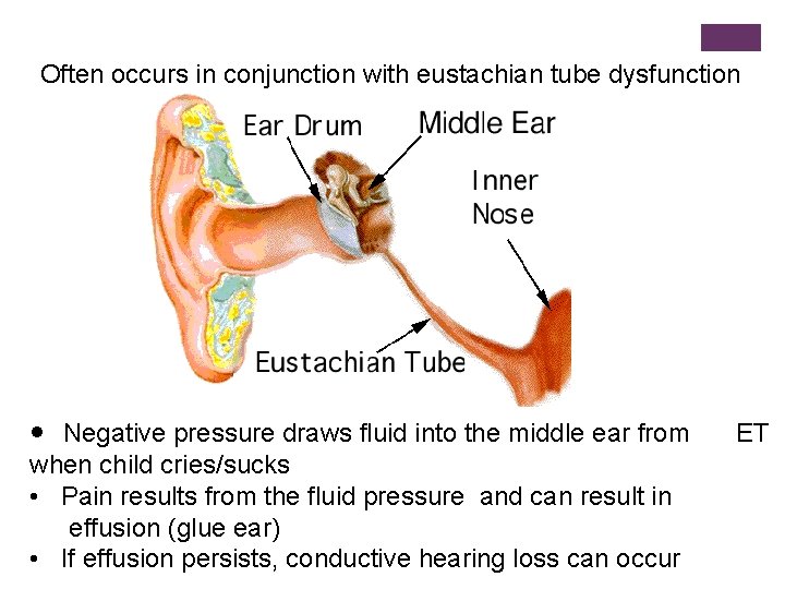 Often occurs in conjunction with eustachian tube dysfunction • Negative pressure draws fluid into