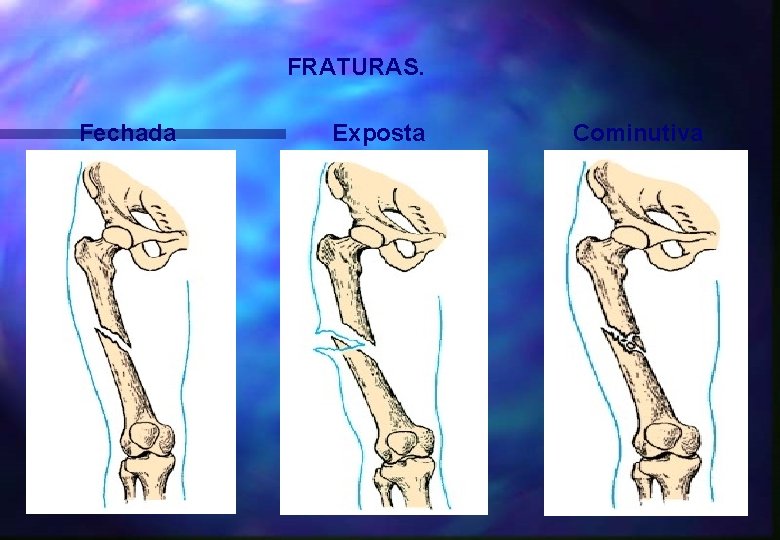 FRATURAS. Fechada Exposta Cominutiva 