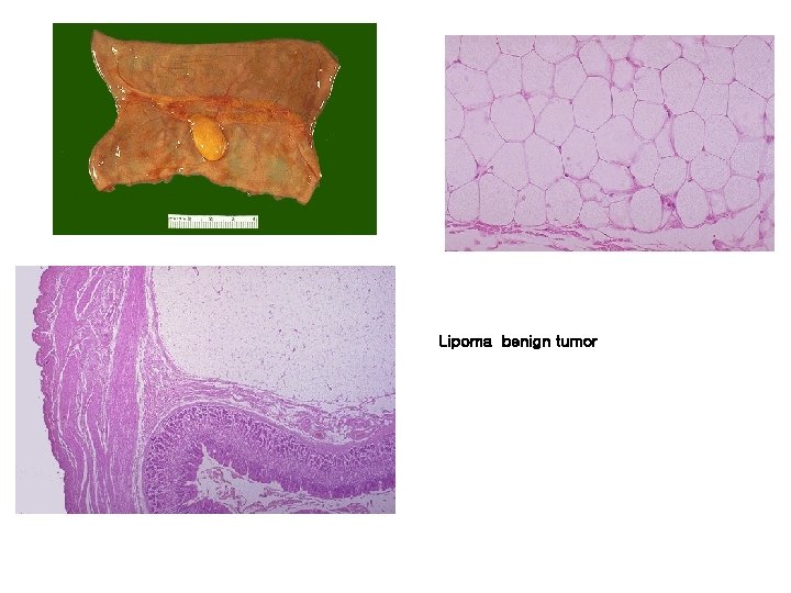 Lipoma benign tumor 