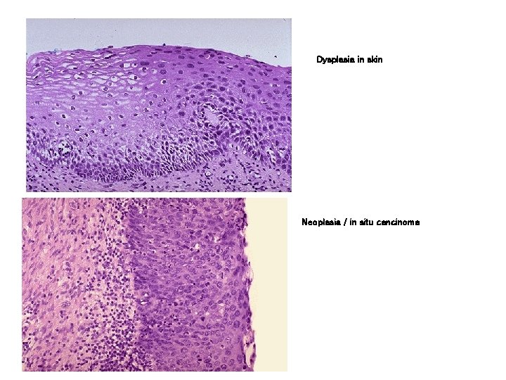 Dysplasia in skin Neoplasia / in situ cancinoma 